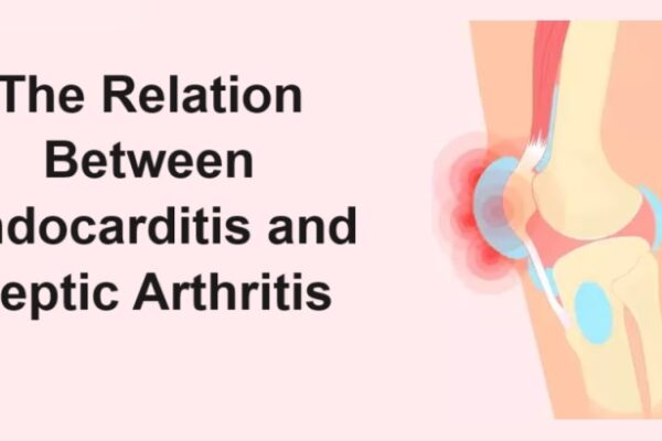 Our heart is the most important organ in our entire body. It facilitates the circulation of blood across all vital organs so as to ensure that we keep living a healthy life without major complications. This article deals with Endocarditis. To learn about this heart disease, refer to the information given below. What is Endocarditis? Endocarditis is an inflammatory heart condition. It happens when the inner lining of the heart gets inflamed. The inner lining is medically known as the Endocardium; thus, inflammation of the Endocardium is Endocarditis. This inflammation is usually caused by bacterial growth within the heart. This heart-related condition isn’t common as it doesn’t usually happen to a healthy heart. Symptoms The symptoms of Endocarditis are often mild and not severe at all. Severe symptoms in this condition develop slowly and often resemble those from various other medical conditions. Because this condition has symptoms also common in other diseases, many cases of Endocarditis might go undiagnosed in the early stages. Endocarditis causes the same physical conditions as typical of the flu and pneumonia. Still, the following are some of the physical changes in the case of Endocarditis. ● The colour of your skin can turn pale; ● You might also experience fever and chills; ● Night sweats are also common; ● Muscle and joint inflammation and thus the concomitant pain and mobility issues occur; ● You might also feel like vomiting with a decrease in your appetite. ● Cough and breathing difficulties are other symptoms. However, all these symptoms don’t surface the next day after you have got Endocarditis. As the infection and inflammation of the inner lining of the heart grows, you become more and more ill in this manner. Causes It has already been mentioned that this condition is caused by the infestation of bacteria inside the lining of the heart. So, the primary cause of Endocarditis is bacteria entering inside your body and entering inside your heart through the bloodstream. There are several reasons as to how bacteria can enter your bloodstream finally ending up in your heart and joints. If you have taken something inside your body already contaminated, this is one way but not all. Falling down and sustaining bruises and scratches on contaminated surfaces, grounds and floors is another way of getting bacteria in. Dealing with someone who is already infected can also facilitate the communication of the infection from one person to another. If you don’t take good care of your oral hygiene or you have gum diseases, this could also become the reason for Endocarditis long run. STDs also cause such infections inside the heart cavity if contracted. Treatments The treatment of Endocarditis mainly depends on antibiotics and surgery. The doctor can put the affected person on antibiotics for a period until the infection and inflammation is completely gone. Endocarditis in its mild stage isn’t serious enough to be fatal. Take your antibiotics on time as prescribed and you will be healthy again to lead a normal life. However, in severe cases, if it is required, a doctor will perform surgical interventions to correct the situation. In this particular surgical case, you might have to be hospitalised for rehabilitation and normal recovery. Post-surgery medical attention is crucial if you want to keep the potential complications at bay. Can Endocarditis cause joint problems? Yes; if the infectious conditions travel all the way from your heart to joints via the bloodstream, it might cause joint problems. This basically happens because your body has joints that contain synovial fluid. This fluid is there to lubricate the joints like your knees or hips. By the presence of such fluid contents, frictional trauma is reduced and as a result, you can walk and mobilise the joint without too much wear and tear. So, bacteria can travel via the bloodstream to any part of the body. If they reach the joint cavity, it can lead to joint inflammation commonly known as Septic Arthritis. What is Septic Arthritis? Septic arthritis is a joint-related inflammation caused by germs. In this condition, joint inflammation gives rise to pain, redness, tenderness and swelling, impacting the joint mobility severely. Germs, bacteria or any other microorganism can enter a joint either through an internal body infection like Endocarditis or directly through any other external events like using a contaminated injection, if a street dog has bitten you etc. If you are looking for the best surgeon well-trained in performing arthroplasty, meet with the best surgeon by visiting the following link: best surgeon for hip replacement surgery. How to prevent Endocarditis The following are effective ways to keep the risk of this heart problem away from you. ● Take care of your oral health; ● Take antibiotics if you have infections; ● Stay away from body piercing; ● Don’t get tattoos done on your skin as it might lead to the invasion of bacteria inside you; ● Practising good hygiene is also crucial; and, ● Don’t use dirty public toilets; All these points are preventative measures for Endocarditis. General tips on keeping your body healthy Furthermore, if you take care of your health, you are less prone to getting Endocarditis. Here are some of the health tips. Adequate Sleep: A good night's sleep is the remedy to many health problems. Prolonged sleep deficiency is linked to compromised immunity and thus various complications. So, sleep for at least 7-8 hours if you are an adult. Strong Immunity: If your immunity isn’t strong, take measures to work on that. You can consume medicines or foods that are intended to help boost immunity. Balanced Diet: After sleep, a balanced diet assumes importance. So, eat meals rich in all forms of macro and micronutrients. Ensure calcium, vitamin D, protein, antioxidants, and all your body needs to function properly. Exercise: This lifestyle element helps by building your strength, flexibility and balance. Exercise regularly and it will help increase your stamina to fight off many infections that might need medical attention otherwise. Timely Dental Check-Ups: If you have dental problems, go for check-ups in time or it will exacerbate the oral conditions. Poor oral health is often associated with increasing the risk of Endocarditis. Timely Management of Infections: If any part of your body gets infected because of some bacterial invasion inside the body, book your appointment with a doctor to deal with it before it gets worse. Conclusion Endocarditis is not a serious disease that can be fatal. However, it is an inflammatory condition that might go unchecked or unnoticed due to mild symptoms and similarities with other health problems in the early stages. Thus, its diagnosis and effective treatment are crucial. In its aggravated form, this condition can also lead to Septic Arthritis causing joint pain and mobility issues. If you have joint problems like chronic and severe knee pain or hip pain and are looking for the best doctor for consultation, refer to the following link: orthopedic doctor in West Delhi.