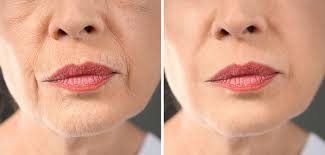 smoke line botox