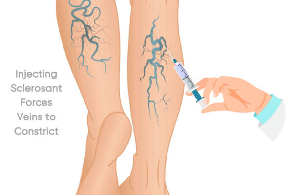 Varicose Veins Treatment: Effective Options for Healthy Legs vericose veins treatment