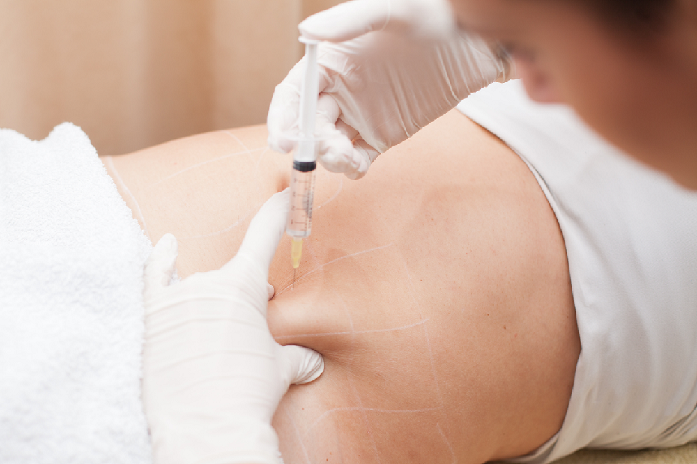 How to Prepare for Fat Dissolving Injections